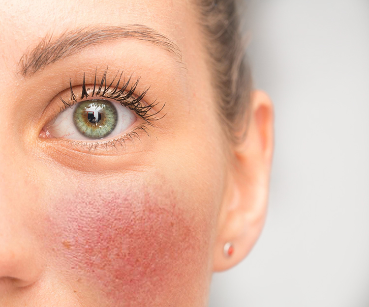 Пилинги в лечении розацеа